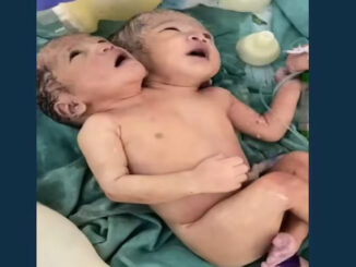 इंदौर में जन्मी दो सिर वाली बच्ची, जान बचाने की जद्दोजहद में जुटे चिकित्सक